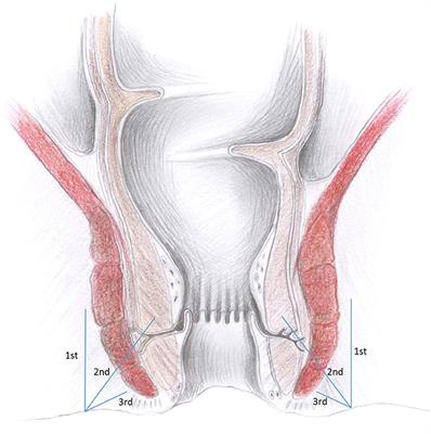 Local Perianal Anesthetic Infiltration Is Safe and Effective for Anorectal Surgery